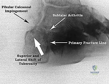 فقدان ارتفاع الكعب