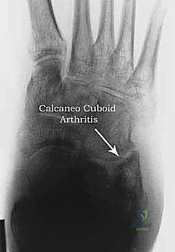 تشوهات المفصل تحت الكاحل