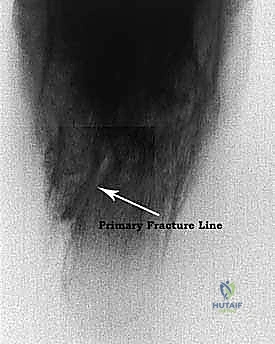اعتلال أوتار الشظية