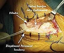 صورة توضيحية لـ جراحة تصحيح سوء التئام عظم العقب وتثبيت المفصل تحت الكاحل في صنعاء