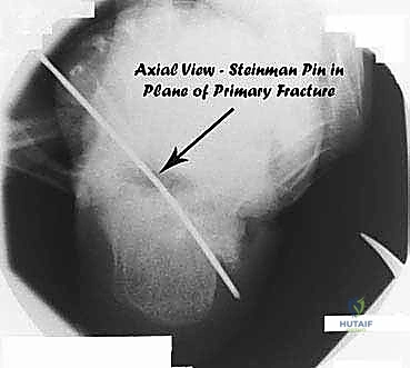 صورة توضيحية لـ جراحة تصحيح سوء التئام عظم العقب وتثبيت المفصل تحت الكاحل في صنعاء