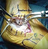 صورة طبية: جراحة تصحيح سوء التئام عظم العقب وتثبيت المفصل تحت الكاحل في صنعاء