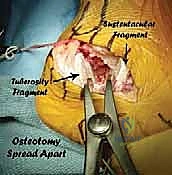 صورة توضيحية لـ جراحة تصحيح سوء التئام عظم العقب وتثبيت المفصل تحت الكاحل في صنعاء