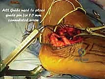 صورة طبية: جراحة تصحيح سوء التئام عظم العقب وتثبيت المفصل تحت الكاحل في صنعاء