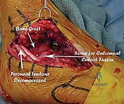 صورة طبية: جراحة تصحيح سوء التئام عظم العقب وتثبيت المفصل تحت الكاحل في صنعاء