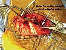 صورة طبية: جراحة تصحيح سوء التئام عظم العقب وتثبيت المفصل تحت الكاحل في صنعاء