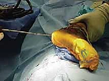 صورة توضيحية لـ جراحة تصحيح سوء التئام عظم العقب وتثبيت المفصل تحت الكاحل في صنعاء