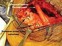 صورة طبية: جراحة تصحيح سوء التئام عظم العقب وتثبيت المفصل تحت الكاحل في صنعاء