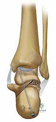 صورة طبية: جراحة تصحيح سوء التئام عظم العقب وتثبيت المفصل تحت الكاحل في صنعاء