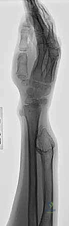 جراحة تشوهات الساعد والأورام العظمية الغضروفية الوراثية المتعددة (MHE): دليل المريض الشامل مع الأستاذ الدكتور محمد هطيف