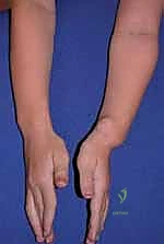 صورة توضيحية لـ جراحة تشوهات الساعد والأورام العظمية الغضروفية الوراثية المتعددة (MHE): دليل المريض الشامل مع الأستاذ الدكتور محمد هطيف