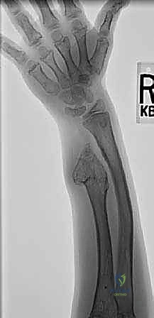 صورة شعاعية توضح انحناء الكعبرة وقصر الزند