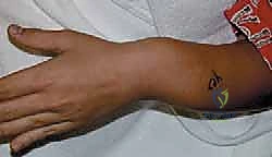 مراحل التئام العظم أثناء فترة الإطالة