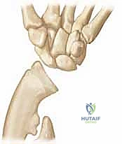 جهاز التثبيت الخارجي وإطالة عظم الزند