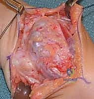 تشريح الساعد وتأثير الأورام العظمية الغضروفية