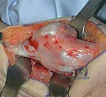 فحص سريري يوضح محدودية الحركة في الساعد