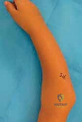 صورة شعاعية تظهر التئام العظم بعد الإطالة