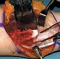 تثبيت الكعبرة بالشرائح والمسامير بعد القطع العظمي