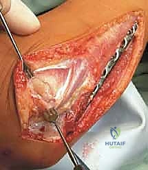 مقارنة قبل وبعد الجراحة توضح تصحيح التشوه