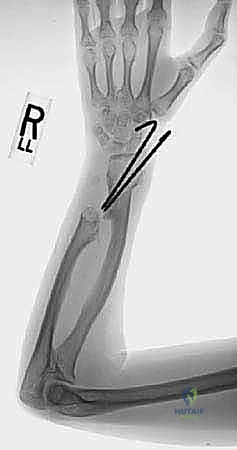 Illustration of radial head dislocation - Dr. Mohammed Hutaif
