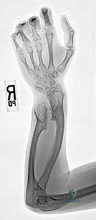 صورة لخطوات التخطيط لعملية القطع العظمي