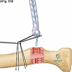 الأعراض السريرية وتشوه العضلة ذات الرأسين بعد التمزق