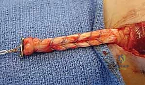 التشريح الدقيق لوتر العضلة ذات الرأسين البعيد وارتباطه بعظم الكعبرة