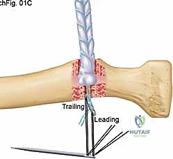 الخيارات العلاجية والتشخيص الإشعاعي لتمزق الوتر