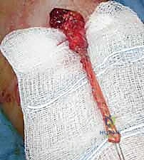 صورة توضيحية لـ إصلاح وإعادة بناء وتر العضلة ذات الرأسين البعيد: دليلك الشامل لنتائج ممتازة مع الأستاذ الدكتور محمد هطيف