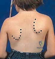 فصل العضلات والوصول إلى العظم الكتفي الفقري