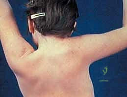 تشوه سبرينجل: فهم شامل وعلاج متقدم بعملية وودوارد المعدلة مع الأستاذ الدكتور محمد هطيف