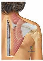 إعادة خياطة العضلات وإغلاق الجرح بعد تعديل وضع الكتف