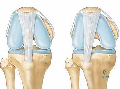 Anteromedial Tibial Tubercle Transfer: A Masterclass in Patellofemoral Rebalancing