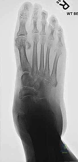 توضيح تشريحي لعملية تثبيت مفصل القدم الثلاثي