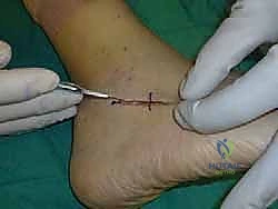 تخطيط المفاصل الثلاثة قبل التثبيت