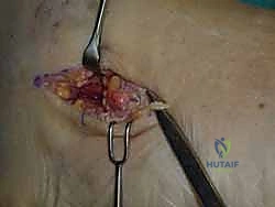 صورة تظهر تشوه القدم المتقدم