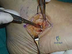 تقييم زوايا التشوه في القدم