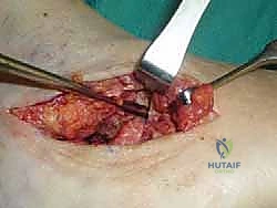 رفع القدم واستخدام العكازات في المرحلة الأولى