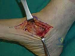 عمل الشقوق الجراحية للوصول للمفاصل