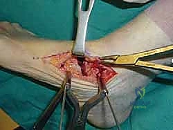 صورة طبية: تثبيت مفصل القدم الثلاثي في صنعاء دليل شامل لاستعادة حركة القدم وتخفيف الألم مع الأستاذ الدكتور محمد هطيف