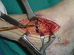 صورة توضيحية لـ تثبيت مفصل القدم الثلاثي في صنعاء دليل شامل لاستعادة حركة القدم وتخفيف الألم مع الأستاذ الدكتور محمد هطيف