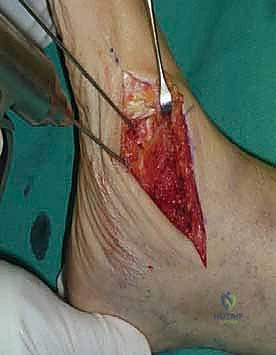 المتابعة بالأشعة السينية في الأسبوع السادس