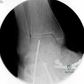 إغلاق الجرح ووضع الجبيرة المبدئية