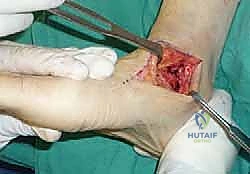 صورة طبية: تثبيت مفصل القدم الثلاثي في صنعاء دليل شامل لاستعادة حركة القدم وتخفيف الألم مع الأستاذ الدكتور محمد هطيف