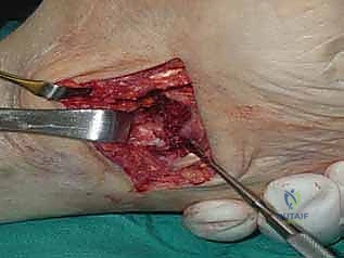 استخدام الطعوم العظمية لملء الفجوات