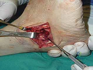 صورة طبية: تثبيت مفصل القدم الثلاثي في صنعاء دليل شامل لاستعادة حركة القدم وتخفيف الألم مع الأستاذ الدكتور محمد هطيف