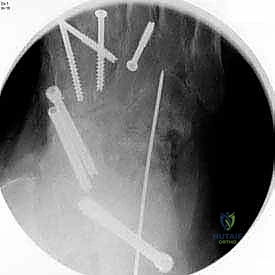 صورة توضيحية لـ تثبيت مفصل القدم الثلاثي في صنعاء دليل شامل لاستعادة حركة القدم وتخفيف الألم مع الأستاذ الدكتور محمد هطيف