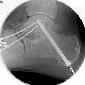 صورة توضيحية لـ تثبيت مفصل القدم الثلاثي في صنعاء دليل شامل لاستعادة حركة القدم وتخفيف الألم مع الأستاذ الدكتور محمد هطيف