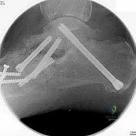 صورة توضيحية لـ تثبيت مفصل القدم الثلاثي في صنعاء دليل شامل لاستعادة حركة القدم وتخفيف الألم مع الأستاذ الدكتور محمد هطيف