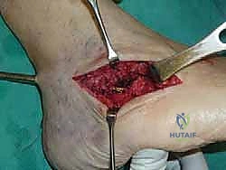 صورة طبية: تثبيت مفصل القدم الثلاثي في صنعاء دليل شامل لاستعادة حركة القدم وتخفيف الألم مع الأستاذ الدكتور محمد هطيف